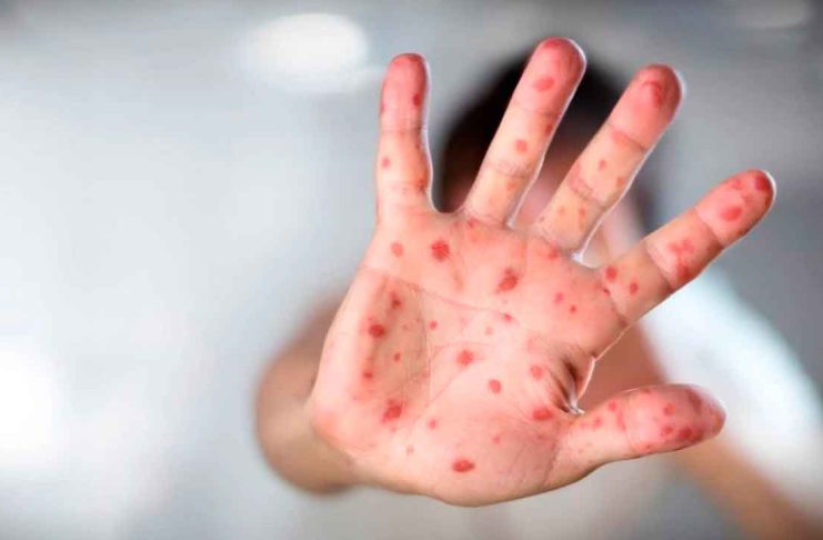 Sarampión repunta en el país y cuatro estados concentran contagios; Michoacán en uno de ellos
