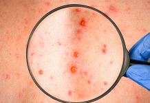 Sarampión repunta en México: más de 8 mil casos y 27 muertes en un año