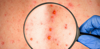 Sarampión repunta en México: más de 8 mil casos y 27 muertes en un año