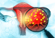 Estudio de la OMS vincula uso prolongado de anticonceptivos orales con mayor riesgo de cáncer cervicouterino