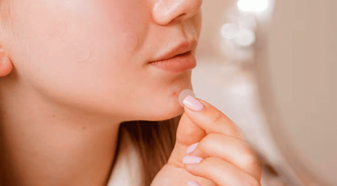 Parche de acné: cuándo son útiles y quiénes deben evitarlos