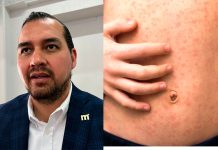 Morelia con un caso registrado de Sarampión