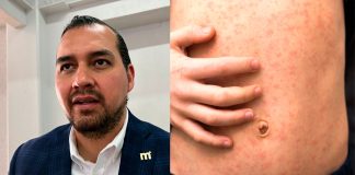 Morelia con un caso registrado de Sarampión