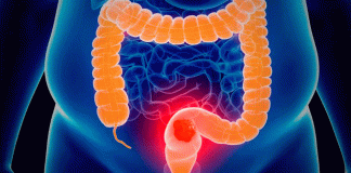 Nuevo tratamiento contra cáncer de colon logra duplicar la supervivencia