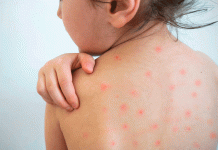 Sarampión en México supera los 11 mil casos y continúa la alerta sanitaria