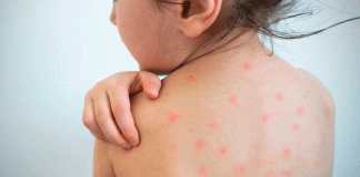 Sarampión en México supera los 11 mil casos y continúa la alerta sanitaria