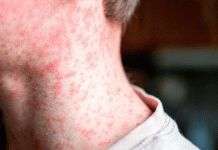 Colombia reporta los primeros casos de sarampión en cinco años