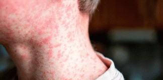 Colombia reporta los primeros casos de sarampión en cinco años