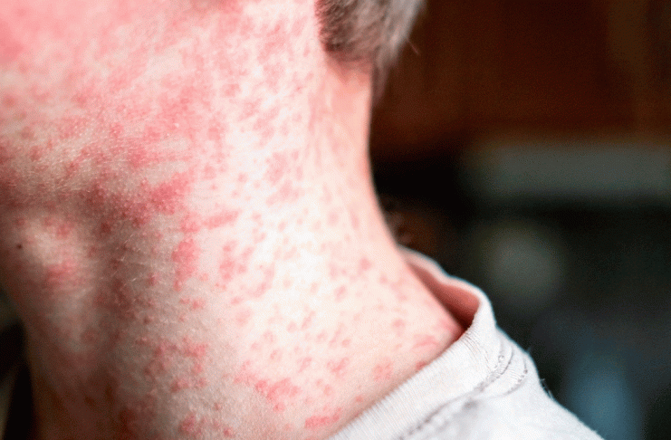 Colombia reporta los primeros casos de sarampión en cinco años