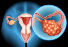 Plantean cambio de nombre para el síndrome de ovario poliquístico por enfoque metabólico