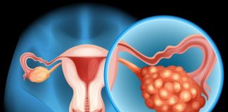 Plantean cambio de nombre para el síndrome de ovario poliquístico por enfoque metabólico