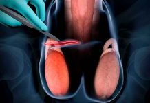 Semana de la Salud Masculina: ¿Es reversible la vasectomía si deseas tener hijos después?