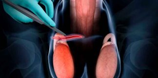 Semana de la Salud Masculina: ¿Es reversible la vasectomía si deseas tener hijos después?