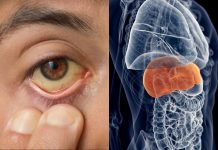 Hepatitis: cuáles son sus tipos, síntomas y las medidas para prevenir esta enfermedad