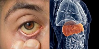 Hepatitis: cuáles son sus tipos, síntomas y las medidas para prevenir esta enfermedad