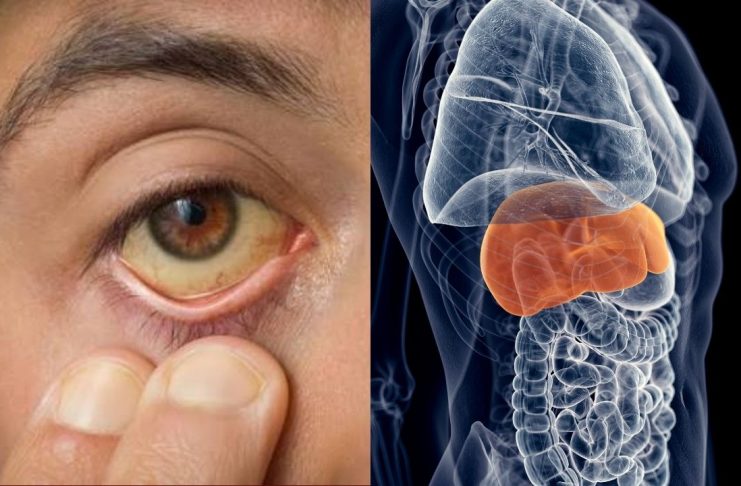 Hepatitis: cuáles son sus tipos, síntomas y las medidas para prevenir esta enfermedad