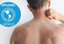 La OPS advierte elevado riesgo por sarampión en las Américas; México ocupa la segunda posición en contagios