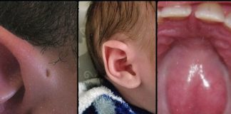 Estas son las “mutaciones” inofensivas más pero comunes en el cuerpo humano