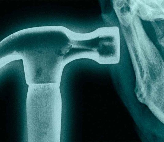 Bone smashing: la peligrosa moda de golpearse la cara con un martillo Joven sosteniendo un martillo cerca de su rostro, en referencia a la peligrosa tendencia viral del bone smashing.